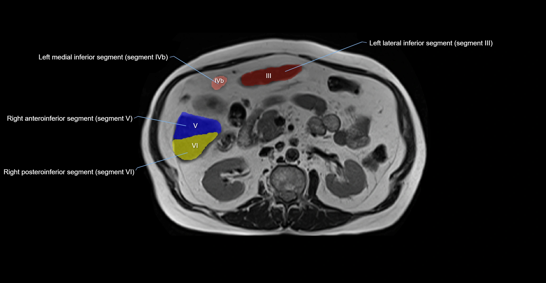 MRI  liver segments anatomy axial cross sectional 3T radiology  image-img-00001-00021.webp